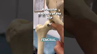 HOW DO YOU GET BONE NECROSIS OF THE HIP [upl. by Oric]