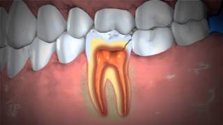 Treatment of Abscessed Teeth [upl. by Tucker]