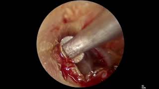 Miringoplastica endoscopica step by step [upl. by Landing978]