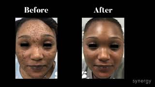 Two Faced Cyspera for Pigmentation Skincare on Two Types of Skin with Medical Aesthetician Emily T [upl. by Huber671]