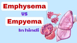 empyema vs emphysema  Difference between emphysema and empyema  nursing class in hindi  empyema [upl. by True378]