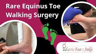 Rare Form of Equinus Toe Walking Surgery Success 6 Month Recovery [upl. by Lossa]