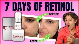 🔺RETINOL BEFORE And AFTER HALF Of HER FACE 🔺  Retinol Serum [upl. by Stoops]