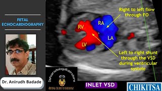 The Relationship Between Patent Foramen Ovale and Migraine [upl. by Edra]