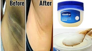 How to Get rid Of Dark Underarms in 3 Minutes  instant result  using Vaseline 100 Effective [upl. by Greenwald260]