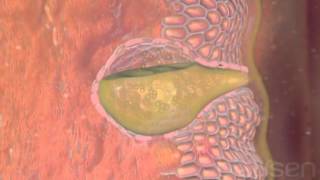 What is Esophageal cancer Treatment Medical animation [upl. by Adnawyek]