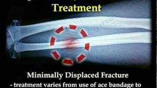 Nightstick Fracture  Ulnar Shaft fracture  Everything You Need To Know  Dr Nabil Ebraheim [upl. by Feingold]