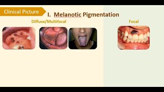 3 Physiologic smokers amp druginduced melanosis [upl. by Manard209]