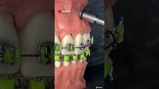 ¡Instalación de microimplante dental en los BRACKETSBRACESFRENILLOS ORTODONCIA [upl. by Eiramanig]