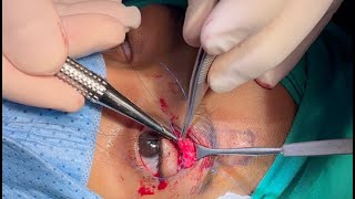 Frontalis Flap for Ptosis Repair [upl. by Namyh868]