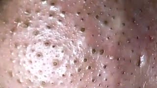 Blackheads amp Whiteheads Satisfying Removal 0004 [upl. by Drona]