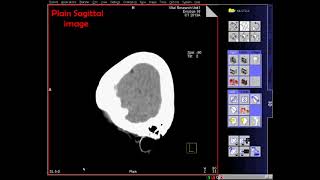 CT Normal Brain Axial Coronal amp Sagittal video [upl. by Mcadams]