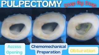 Pulpectomy ⚪️ Step By Step Demonstration 🔵 Baby Blue Pediatric Rotary Endodontic Files [upl. by Velick90]