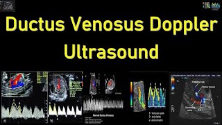 Fetal Ductus Venosus Doppler Ultrasound Interpretation [upl. by Marcellina]