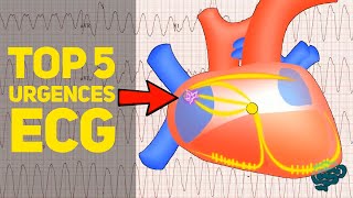 🔴 Le TOP 5 des Urgences à lEcg EXPLIQUÉES CLAIREMENT  ​ [upl. by Johppah]