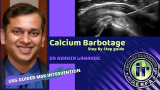 Calcium Barbotage by Ashwin Lawande [upl. by Esidnac]