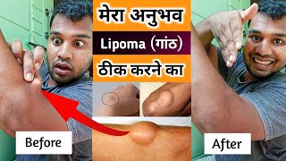 Lipoma Natural Treatment  Lipoma Ko Kaise Theek Karen  Lipoma Treatment By Exercise [upl. by Gudren123]