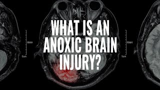 What is an Anoxic Traumatic Brain Injury I The McCraw Law Group [upl. by Ver]