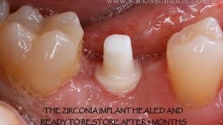 Zirconia Implant [upl. by Ahseuqal340]