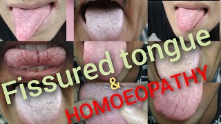 CRACKS amp fissures on tongue 👅  🩺Dr SANDEEP SAIRAL [upl. by Hcirteid282]