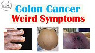 Colon Cancer Weird Symptoms amp Why They Occur [upl. by Camroc693]