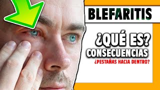 🟠 ¿Qué es la BLEFARITIS en los ojos Cap 1 [upl. by Brey]