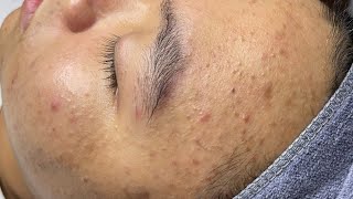 Blackheads amp Pimples Pore Removal New 2024  Acne Treatment With Bo Nguyễn Spa [upl. by Derwin]