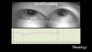 Xlinked adrenoleukodystrophy presenting with positional downbeat nystagmus [upl. by Tandie]