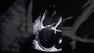 Large Atrial Septal Defect echocardiography echocardiogram cardiology [upl. by Quita]