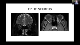 Neurosarcoidosis Presentation – Neurosarcoidosis Patient Day 2022 [upl. by Enialem]