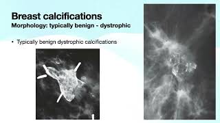 Breast Calcifications Part 1  Free Radiology CME [upl. by Ardnyk]