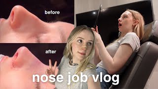 nose job vlog  rhinoplasty recovery amp results [upl. by Fiedling]