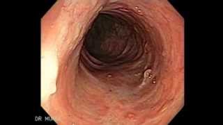 Colonoscopy of Ulcerative Colitis [upl. by Kciredorb]