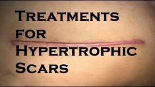 Treatments for Hypertrophic Scars [upl. by Ludmilla]