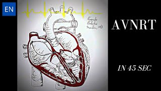 Atrioventricular Nodal Reentry Tachycardia AVNRT Animation and ECG Shorts [upl. by Mchugh]