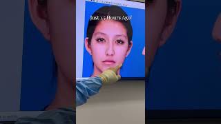 Watch This STUNNING Rhinoplasty Case [upl. by Drapehs]