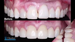 Case of the Week Replacing Unesthetic Direct Composite Veneers [upl. by Breban626]