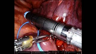 Robotic Segmentectomy Lateral Segment of RML RS4 [upl. by Florencia125]