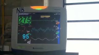 心電図モニター 実際の測定 Ventricular Tachycardia VT心室頻拍 NIHONKOHDEN Vismo [upl. by Aihtniroc480]