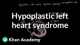 Hypoplastic left heart syndrome and norwood glenn fontan  NCLEXRN  Khan Academy [upl. by Anwahsak]