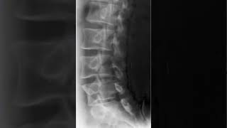 Lumbar Spine Oblique Radiology Tutorial [upl. by Lleihsad]