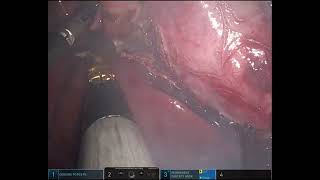 Robotic cholecystectomy for GB empyema [upl. by Mllly364]