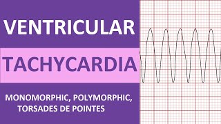 Ventricular Tachycardia Vtach ECG Interpretation Treatment Nursing NCLEX Review [upl. by Analrahc45]