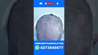 Transform Your Receding Hairline Into Best Hair Transplant Result In Just 6 Months hair [upl. by Nivac]