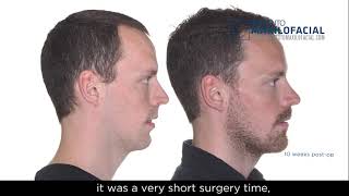 Jaw surgery Case  104 Johan  Sleep apnea maxillomandibular retrusion [upl. by Durand]