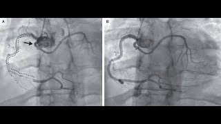 Spontane Koronararteriendissektion [upl. by Gale101]