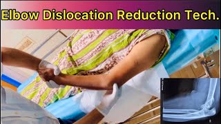 Elbow Dislocation Reduction How to Reduce Posterior Dislocation Elbow with patient in Supine positn [upl. by Gruver]