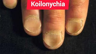 Leukonychia Platynychia and Koilonychia in Chronic iron deficiency anemia [upl. by Filmore]