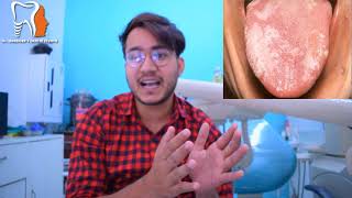 मुंह में सफेद दाग  Leukoplakia causes amp treatment  DR CHANDER UDHEY  WHITE SPOTS  RED SPOTS [upl. by Farrington]