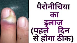 Nail Infection Paronychia  Cause amp Treatment  नाखून संक्रमण का इलाज कैसे करें [upl. by Murdock]